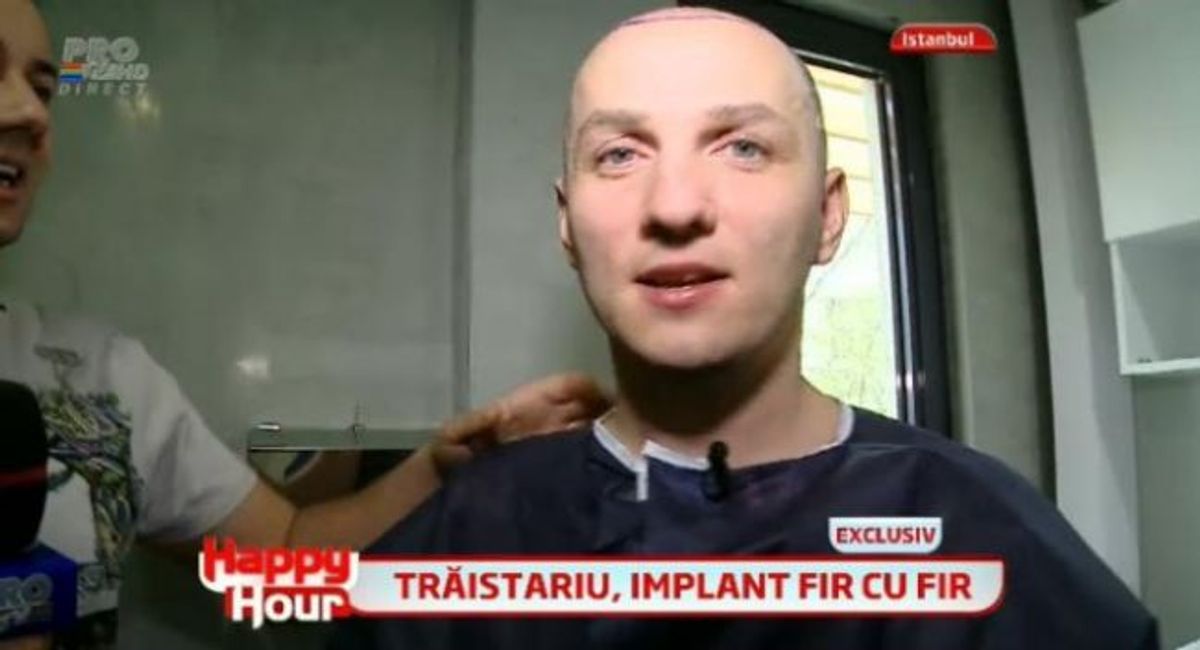 Transplantul De Par A Fost Un Succes Lui Mihai Traistariu I A Crescut