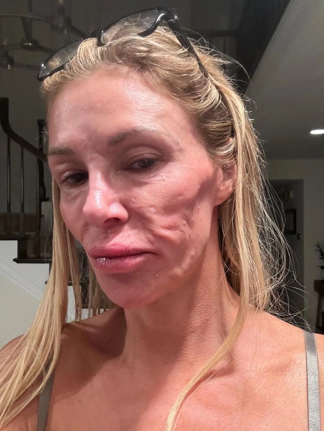 Brandi-Glanville-Says-Face-Parasites-Have-Disfigured-Her-Spent-70K-to-Fix-330