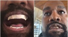 Lui Kanye i-a “crescut” ceva pe față, iar fanii sunt alarmați. Cum explică medicii umflătura de pe buza rapperului