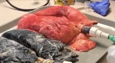 Imagini socante arata diferenta dintre plamanii unui fumator si al unui nefumator