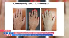 VIDEO Rejuvenarea mâinilor, o procedură nedureroasă
