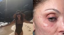 Și-a distrus fața din cauza unui prosop de la hotel! Cum s-a postat o antreprenoare de top după ce a făcut o infecție bacteriană pe față, în timp ce era în vacanță: „Nu le folosiți niciodată!”