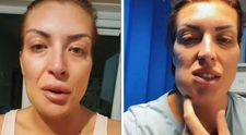 O femeie a mers în Turcia pentru a obține un zâmbet de Hollywood, însă s-a ales cu fața mutilată