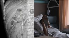 Caz absolut halucinant! Un tânăr, ajuns de urgență la spital cu dureri abdominale, avea de 20 de ani un obiect în stomac! Ce i-au descoperit medicii