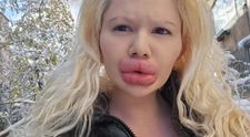 Ea este femeia cu cele mai mari buze din lume! Dentiștii o refuză din cauza operațiilor estetice: „M-a privit cu dezgust”