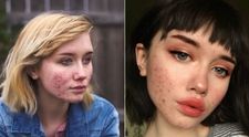 O adolescenta a inspirat tineri din intreaga lume cu povestea ei. Cum a reusit sa isi infrunte problemele cu acneea