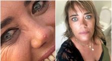 A rămas îngrozită! Ce a pățit o femeie după ce și-a spart un coș de pe nas