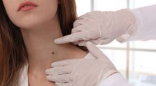 VIDEO Alunițe, la control! Urmărirea dermatoscopică a alunițelor se face manual și digital