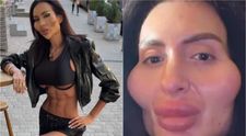 Acum deține recordul pentru cei mai mari pomeți din lume, dar în trecut era superbă! Cum arăta Anastasia Pokreshchuk înainte ca operațiile estetice să-i mutileze fața