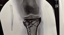 Cum arată piciorul schioarei Lindsey Vonn după operația cu numărul 5: „Acum sunt cu adevărat bionică. A fost nevoie de multe plăci şi şuruburi pentru a reface osul”