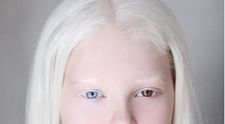Amina, fetița cu albinism de o frumuseţe nepământeană uimește întreaga lume. A fost descoperită de o fotografă