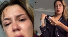 Emily Burghelea și-a șocat fanii. A apărut pe internet cu fața umflată și cu vânătăi pe corp