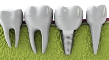 (P) Ce este, când ai nevoie și cum se face un implant dentar București?