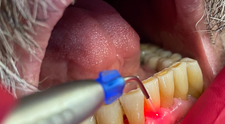 (P) Tratamentul parodontozei cu laserul – #LifeDentistii oferă 7 sfaturi pentru a preveni recidiva!