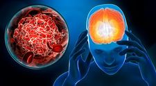 Accidentul Vascular Cerebral (AVC) - ce este și cum îl recunoaștem. Testul care își poate salva viața
