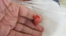 Cazul incredibil al unui bebelus nascut prematur la 12 saptamani
