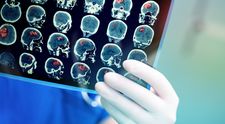 Și-a făcut un RMN pentru durerile de spate, dar medicii i-au descoperit o tumoare cerebrală. Simptomele banale pe care le-a ignorat o femeie de 38 de ani: „Am crezut că o să mor”