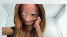 Adalia Rose, vedeta YouTube cu boala 
