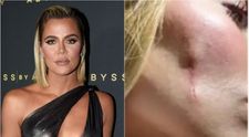 Khloé Kardashian, fotografie tulburătoare din lupta sa cu cancerul! Vedeta și-a îndepărtat tumora de la nivelul feței: „Mi-au schimbat chipul”. Cum arată acum