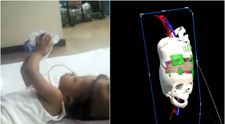 Gemene siameze cu craniile lipite, separate cu succes prin intervenții asistate de Inteligența Artificială. Cum arată acum fetele în vârstă de trei ani