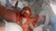 Nascuta prematur, atat de devreme incat i se observa creierul prin pielea capului. Povestea emotionanta a micutei Hailie