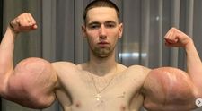 Popeye din Rusia, la un pas de moarte. Și-a scos implanturile din bicepși pentru a-și salva viața
