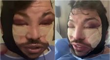 Operațiile estetice l-au distrus pur și simplu! S-a afișat cu fața tumefiată, nici nu mai poate vorbi, iar fanii sunt complet șocați: „Aștept procesul de vindecare”