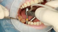 (P) Ai nevoie de un implant dentar? Iată ce trebuie să știi!