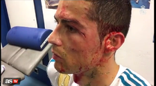 Cum arata fata lui Cristiano Ronaldo dupa ce i s-a cicatrizat taietura care l-a umplut de sange!