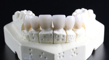 (P) Lucruri neadevărate spuse despre coroanele dentare