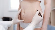 Liposucția, intervenția care ne sculptează corpul