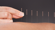 (P) Beneficiile acupuncturii