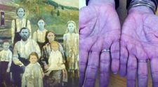 Membrii unei familii s-au înrudit atât de mult, încât pielea lor a devenit albastră. Mărturiile unuia dintre descendenți