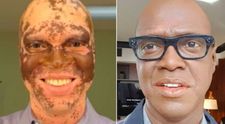 Sufera de vitiligo si este nevoit sa se machieze in fiecare zi pentru a nu-si pierde slujba