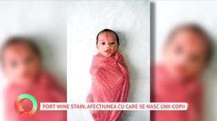 Port wine stain, afecțiunea cu care se nasc unii copii