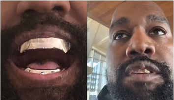 Lui Kanye i-a “crescut” ceva pe față, iar fanii sunt alarmați. Cum explică medicii umflătura de pe buza rapperului
