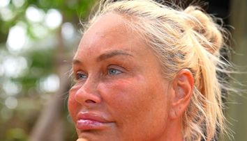 Ce s-a întâmplat cu fața Vicăi Blochina la Survivor România: „Aveam bube peste tot”