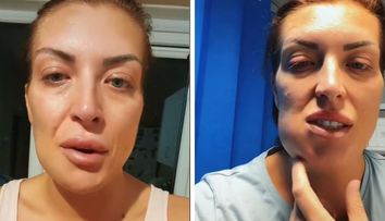O femeie a mers în Turcia pentru a obține un zâmbet de Hollywood, însă s-a ales cu fața mutilată