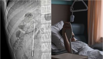 Caz absolut halucinant! Un tânăr, ajuns de urgență la spital cu dureri abdominale, avea de 20 de ani un obiect în stomac! Ce i-au descoperit medicii
