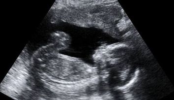 O mamica i-a aratat unei prietene ecografia fetitei sale. Detaliul pe care l-a observat a luat cu asalt internetul
