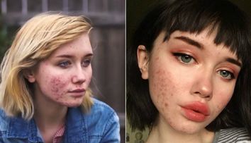 O adolescenta a inspirat tineri din intreaga lume cu povestea ei. Cum a reusit sa isi infrunte problemele cu acneea