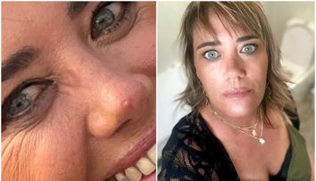 A rămas îngrozită! Ce a pățit o femeie după ce și-a spart un coș de pe nas