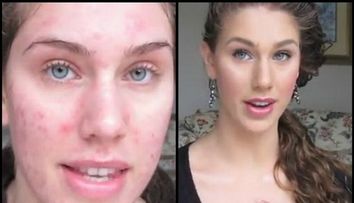 Transformare incredibila: cum reuseste o tanara cu tenul plin de acnee sa aiba un ten impecabil