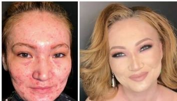 Transformare incredibila. Ea este make-up artistul magician, care face ca acneea severa sa dispara ca prin minune