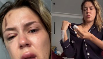 Emily Burghelea și-a șocat fanii. A apărut pe internet cu fața umflată și cu vânătăi pe corp