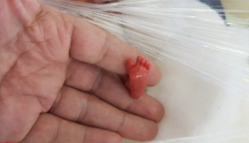 Cazul incredibil al unui bebelus nascut prematur la 12 saptamani