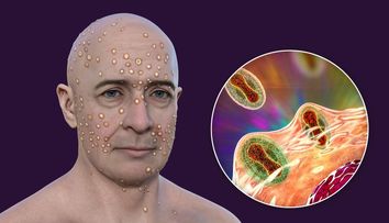 Variola maimuței (mpox), urgență de sănătate globală! Anunțul îngrijorător făcut de OMS