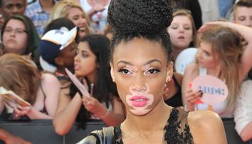 Winnie Harlow este complet diferita fata de alte modele. Imaginile care vor schimba modul in care iti apreciezi trupul