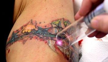 Ca un desen sters in Photoshop. Cum se indeparteaza cu laserul un tatuaj si cum arata pielea dupa aceea: VIDEO