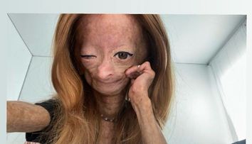 Adalia Rose, vedeta YouTube cu boala 